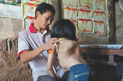 有嚴重脊椎畸形及胸腔隆突病的李文霞。