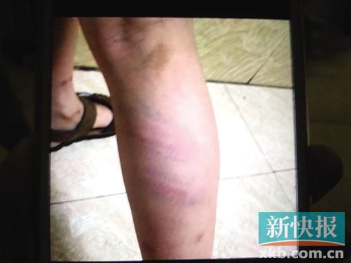 小宇腿部有明顯瘀痕。 翻拍自家屬手機