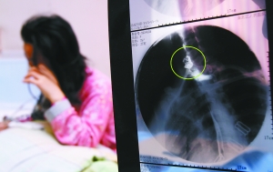 假牙上的鋼絲刺破食管，而薄薄的食道壁緊貼主動(dòng)脈血管，極易造成血管破裂