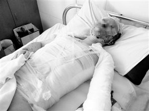 周小姐的頭、頸、軀干、四肢均被燒傷，其中面部燒傷最為嚴重。