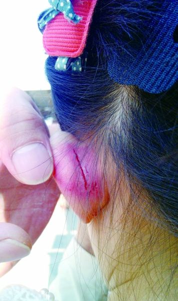　　女童的耳朵被老師揪裂。圖片由女童家人提供