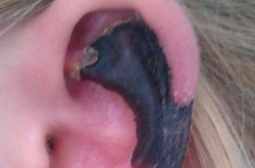 荷蘭女子旅游途中被蜘蛛咬，耳軟骨溶解變黑。