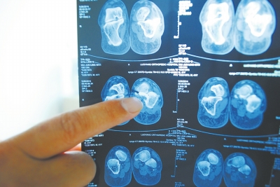 X光片顯示,確實(shí)有一根殘留的螺絲釘。