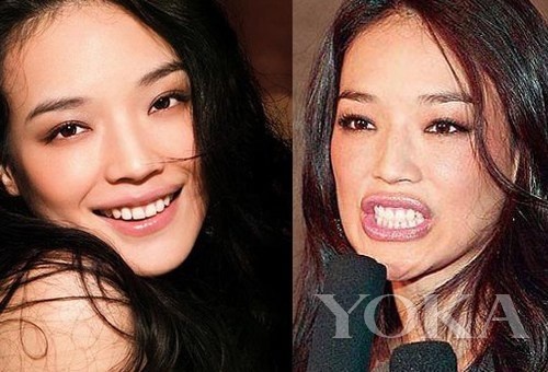 牙齒凸出，口輪肌過于松弛