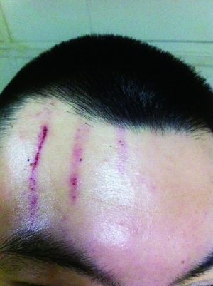 　2013年，被打者受傷照