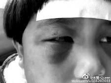 6月2日，網(wǎng)曝渭南市臨渭區(qū)一不滿5歲的女童遭奶奶毆打，眼圈青腫，引起網(wǎng)友關(guān)注，但孩子父母和爺爺均稱是摔倒導(dǎo)致。相關(guān)部門介入調(diào)查發(fā)現(xiàn)確為奶奶毆打所致，鑒于其身體原因已進(jìn)行批評(píng)教育。