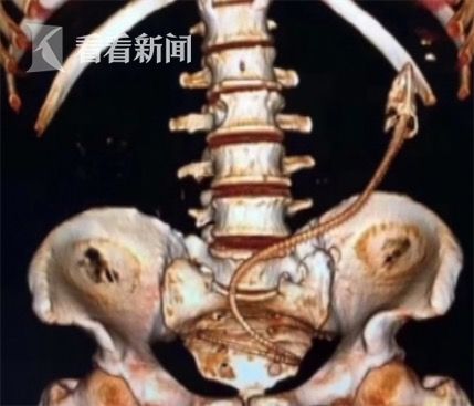 黃鱔從肛門鉆進(jìn)肚子 男子被送醫(yī)不愿多談事情經(jīng)過(guò)