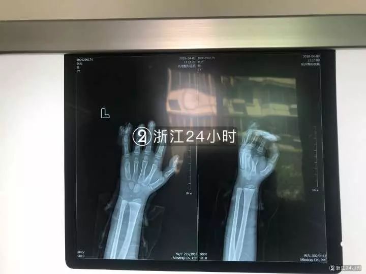 嚇哭！6歲男孩被夾斷手指 罪魁禍?zhǔn)拙故切７? oldsrc=