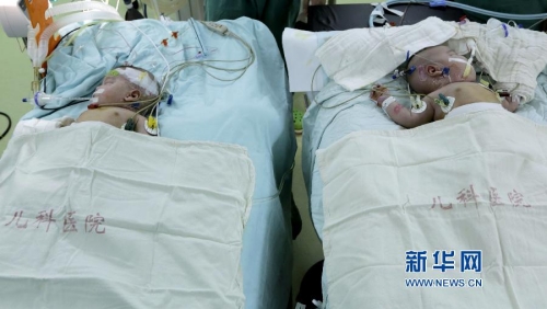 一對(duì)連體女?huà)氤晒Ψ蛛x