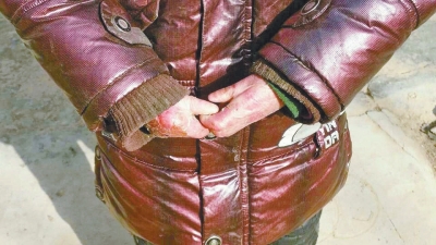 長(zhǎng)期受損的手指，已經(jīng)長(zhǎng)在了一起。