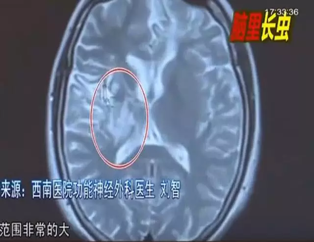 少女大腦皮層萎縮 醫(yī)生從她腦子里捉出5厘米蟲子 少女大腦皮層萎縮 醫(yī)生從她腦子里捉出5厘米蟲子