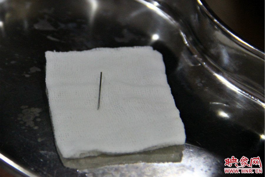 上午11點(diǎn)30分許，小龍腦中鋼針已經(jīng)成功取出。