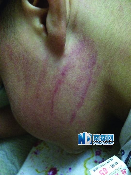 小逸臉上淤痕清晰可見。
