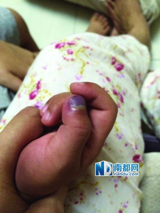小逸手指被夾傷。