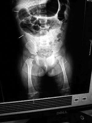 目前體內(nèi)的12根鋼針多分布在孩子的臀部，一根在腹部，其余3根在胸腔附近，其中一根很接近心臟