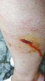 郭女士腿上被猴子咬的傷口。(受訪者供圖)