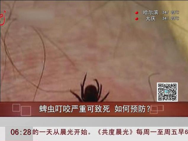 蜱蟲叮咬嚴(yán)重可致死如何預(yù)防？