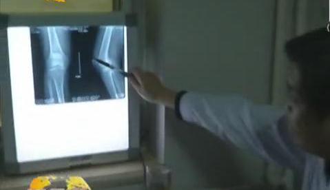 冷空氣來(lái)襲 如何預(yù)防老寒腿？